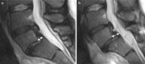 Fast Spin Echo Fse T Weighted Magnetic Resonance Images Mri In The