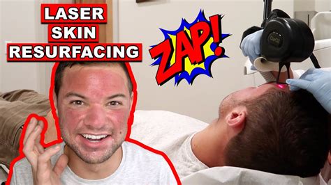 Laser Skin Resurfacing Getting Fractional C02 Laser Procedure For Acne Scar Removal Youtube