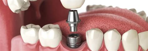 Facts About Dental Implants Dr Motiwala Dental Clinic Implant Centre