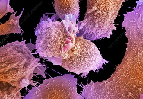 Lung Cancer Cells Sem Stock Image C Science Photo Library