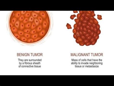 Differences Between Benign Tumors And Malignant Tumors Youtube