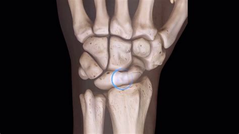 What Is A Scapholunate Ligament Injury – Otosection