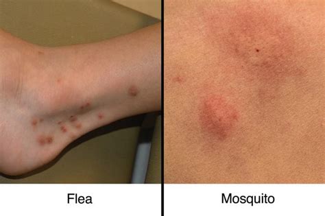 Fleabites Vs Mosquito Bites How To Tell The Difference The Healthy