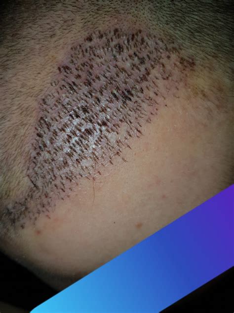 Hair Transplant Gone Wrong Hair Restoration Questions And Answers