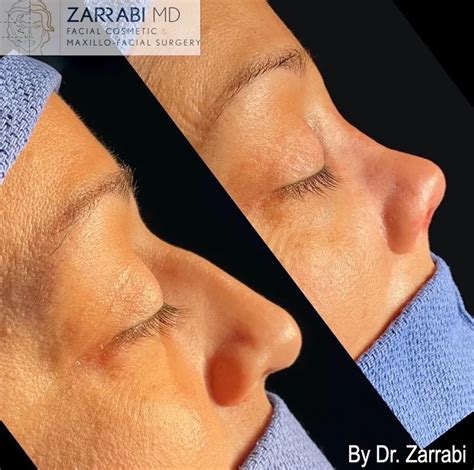 Closed Ultrasonic Piezo Rhinoplasty Dr Shahrouz Zarrabi Md