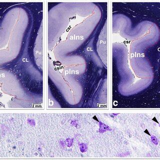 Stimulation Position Dependance Of The Antidepressant Efficacy And Bold