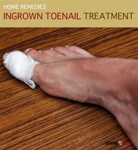 Home Remedy & Ingrown Toenail Treatment - Homestead & Survival