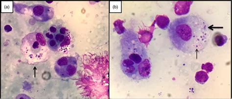 Figure 1 From Hemophagocytic Lymphohistiocytosis Secondary To Aids