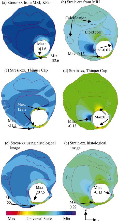 Tracking Of Stress P1 At A Thin Cap Point From 2D And 3D FSI Models