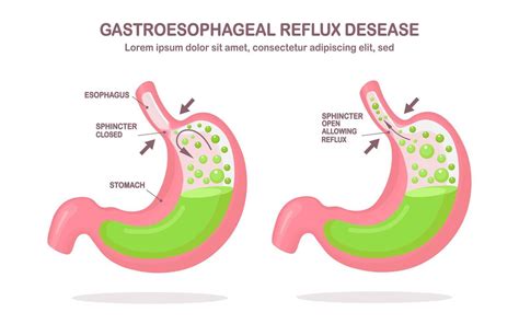 menschlicher Magen gastroösophageale Refluxkrankheit Gerd Sodbrennen