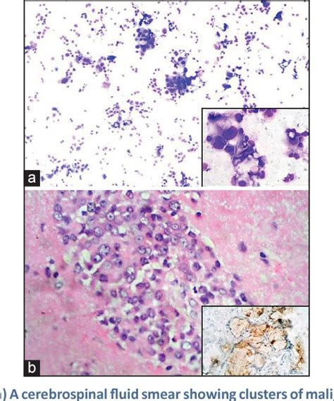 Figure 1 From Role Of Cerebrospinal Fluid Cytology In ‘carcinomatous Meningitis Masquerading As