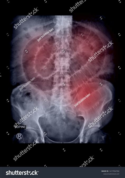 Film Xray Supine Abdomen Radiograph Show Stock Photo 1417504760