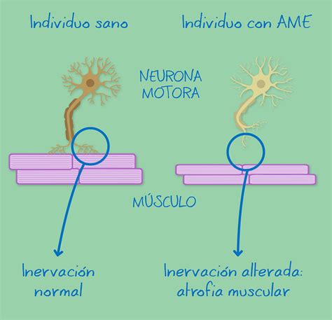 Atrofia Muscular Espinal