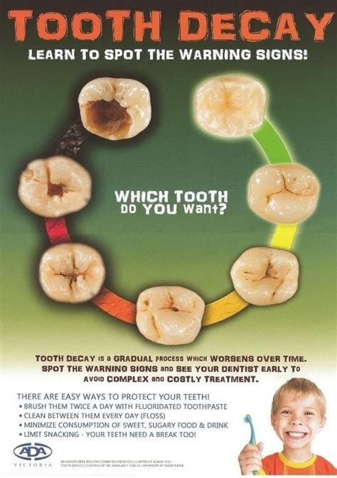 A diagram showing the stages of formation of cavity. | Dentistry ...