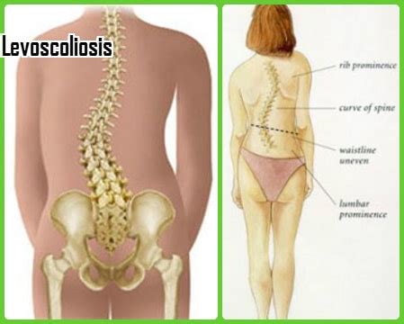 Levoscoliosis What Is Symptoms Causes Treatment