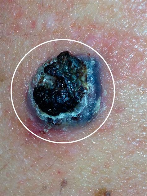 Melanoma Nodular Instituto C Ncer De Piel