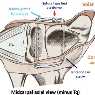 Axial view of midcarpal joint with triquetral (Tq) bone removed. Both ...