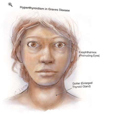 Endocrine Thyroid And Parathyroid Disorders Flashcards Quizlet