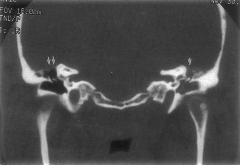 Coronal temporal bone computed tomography image demonstrating... | Download Scientific Diagram