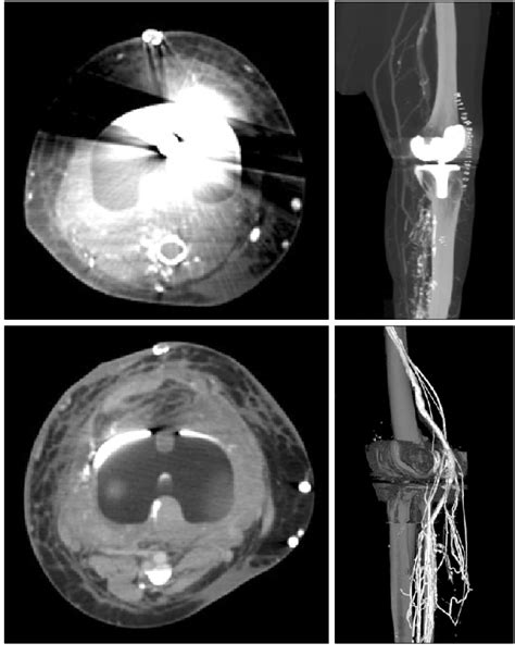 Figure From Diagnosis Of The Deep Vein Thrombosis With Multidetector