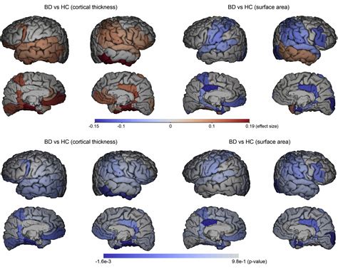 Longitudinal Structural Brain Changes In Bipolar Disorder A