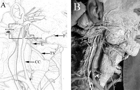 Schematic Drawing A Of The Lateral Right View Of The Dissected Neck