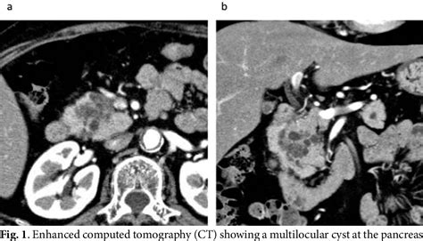 Figure 1 From A Case Of Serous Cystadenoma Communicating With A