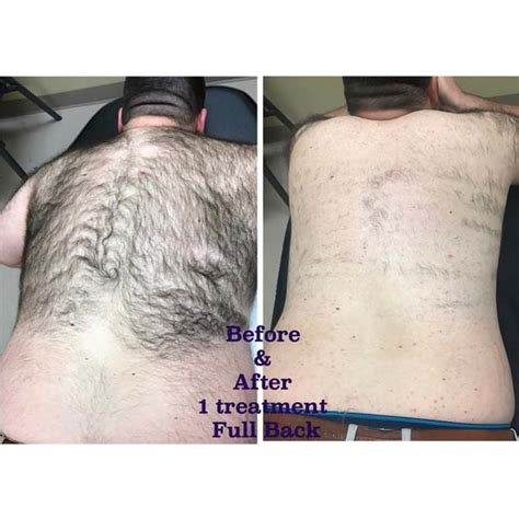 Hair Growth After Laser Hair Removal Best Sale