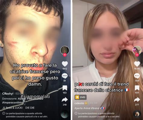 Tiktok L Antitrust Indaga Sulla Pericolosa Sfida Cicatrice Francese