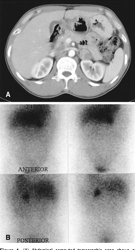 Figure 1 From A Case Of A Composite Adrenal Medullary Tumor Of Pheochromocytoma And