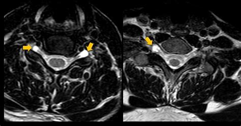 Ultimate Radiology Perineural Cysts Tarlov Cysts Of The Cervical Spine