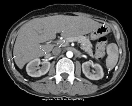 CT Abdomen Anatomy Quiz Radiology Case Radiopaedia Org