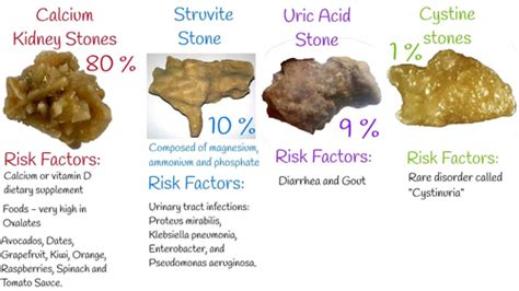 Renal: Kidney stones Flashcards | Quizlet