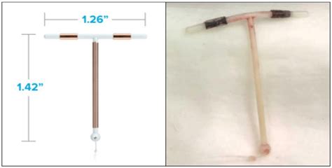 Left Paragard Copper Iud Right Copper Iud Removed From Patient 2