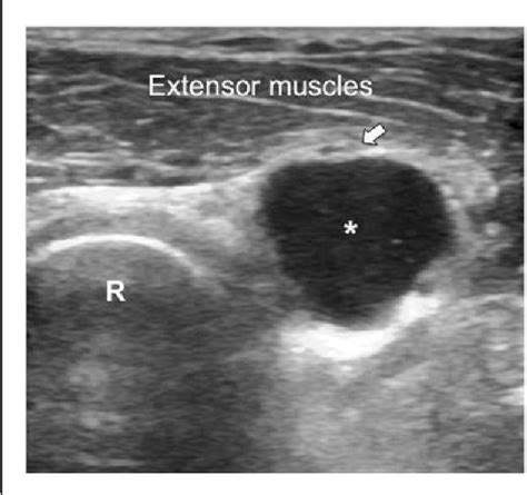 Figure From Calcinosis In Juvenile Dermatomyositis Is Influenced By