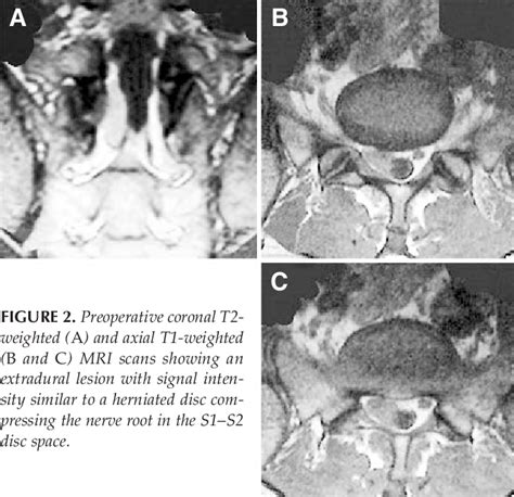 Figure From Acute Presentation Of Spinal Epidural Cavernous Angiomas