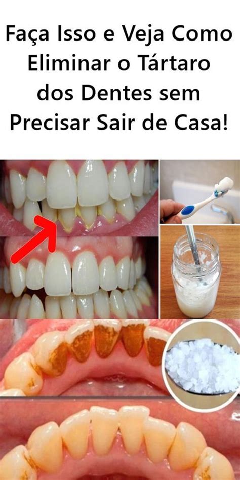 Remover Tartaro Em Casa - Receita caseira para remover o tártaro em 2 minutos (Passo a Passo ...