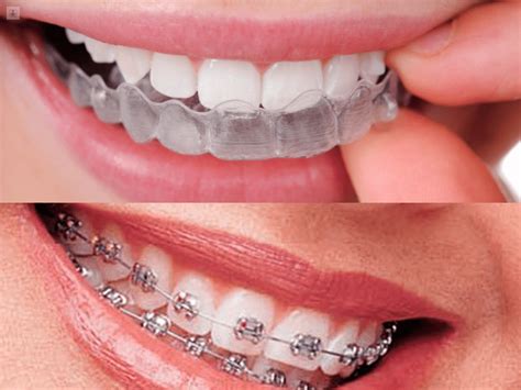 Beneficios De La Ortodoncia Sin Brackets Top Doctors