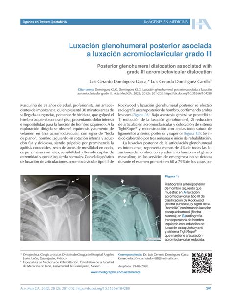 PDF Luxación glenohumeral posterior asociada a luxación