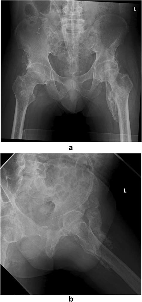 Embolization Followed By Resection Of The Heterotopic Hip Joint Ossification With Spinal Cord