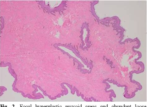 Figure 2 From A Case Of Giant Fibroepithelial Polyp Of The Vulva Semantic Scholar