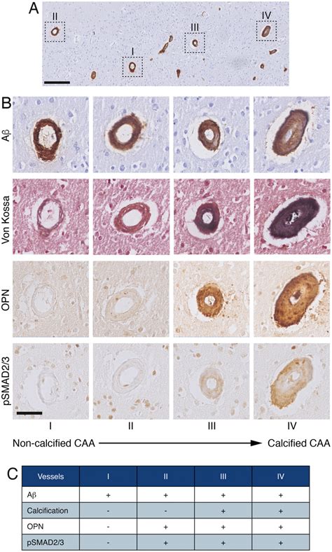 Adjacent Cortical Angiopathic Vessels Showing Different Degree Of