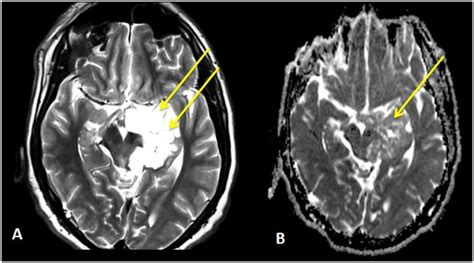 Diffusion Weighted Mri Role In The Differential Diagnosis Of The Brain