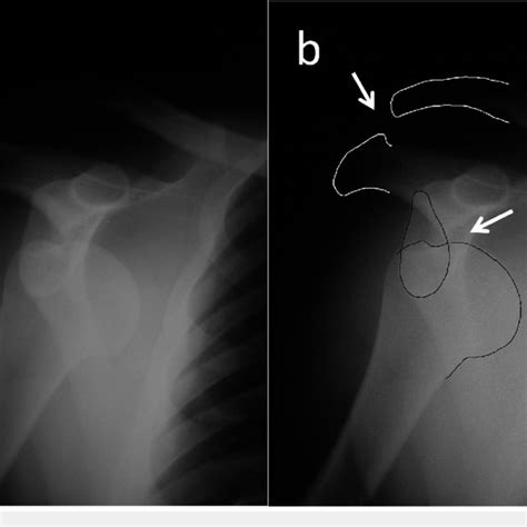 Figure Radiograph Of Bilateral Inferior Shoulder Dislocations Humeral Download Scientific