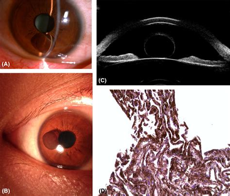 Surgical Removal Of A Free‐floating Iris Cyst In Anterior Chamber In A