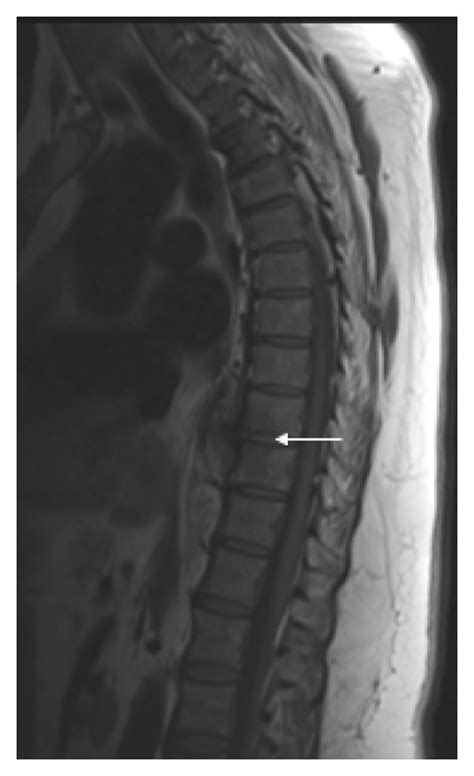 Tuberculous Osteomyelitis Postcontrast Axial A And Sagittal B