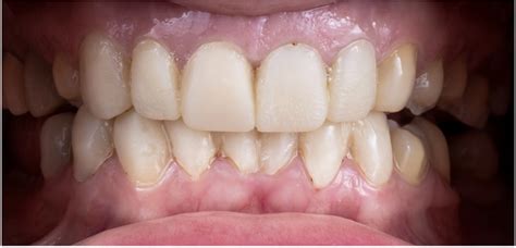 Common types of dental veneers | FindGlob