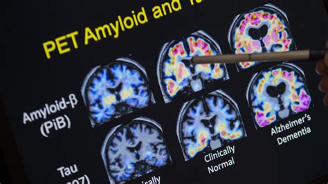 Alzheimers Breakthrough Early Diagnostic Based On Brain Scans