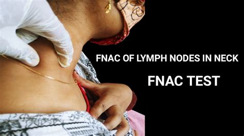 Fnac Test For Lymph Nodes In Neck Youtube