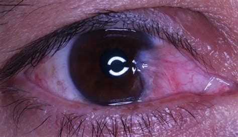 pterygium-example - Boxer Wachler Vision Institute